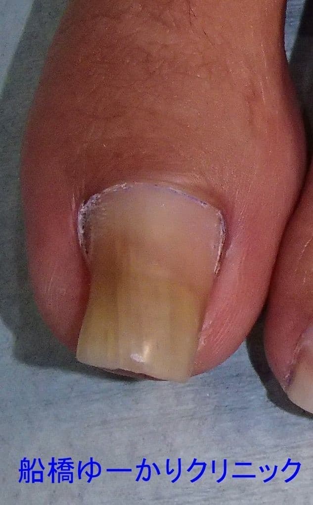 巻爪