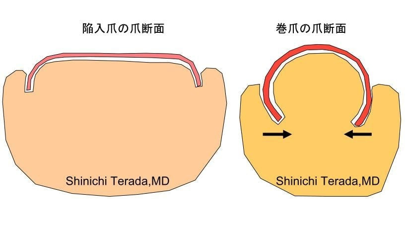 巻爪イラスト
