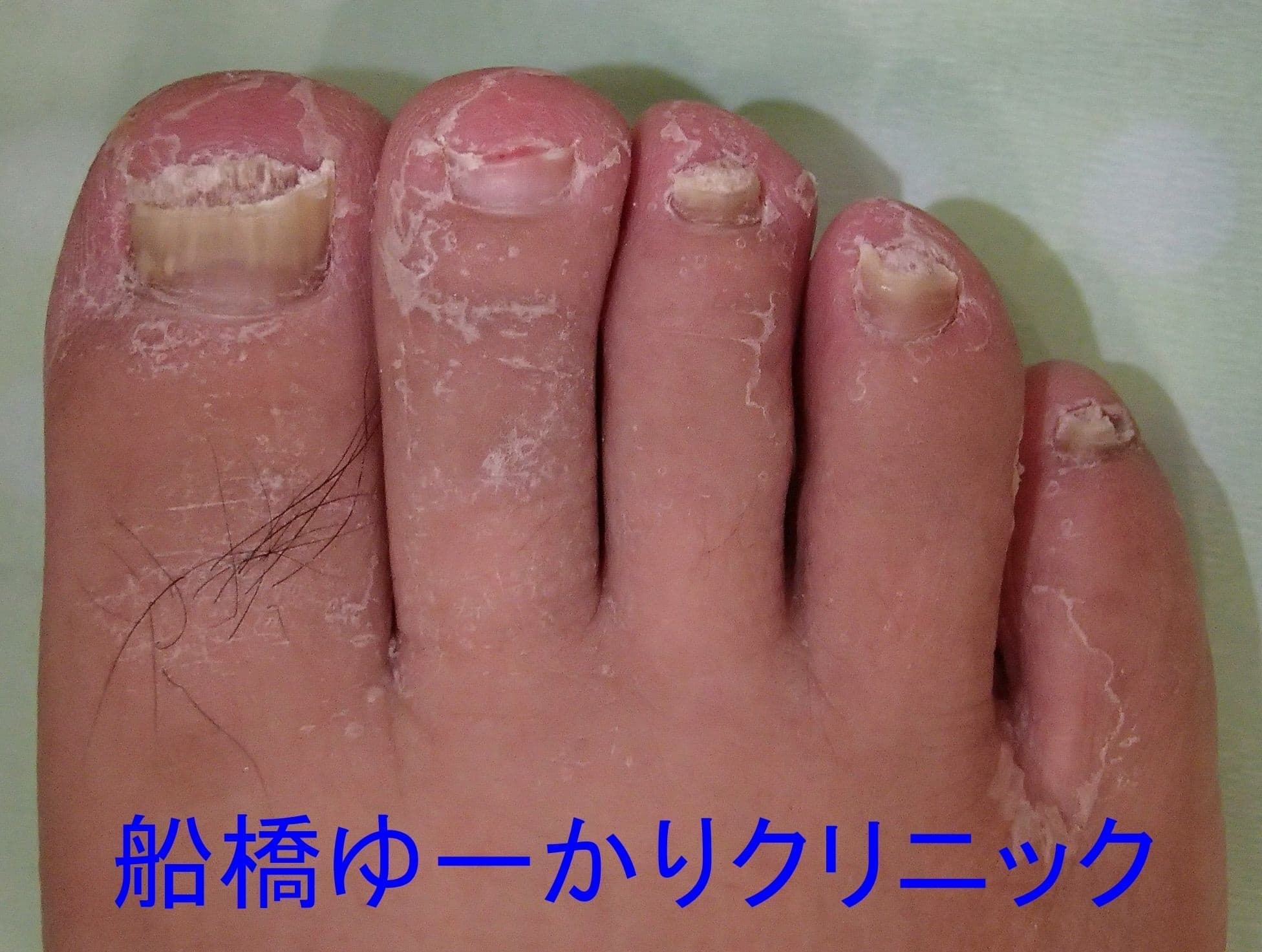 足白癬