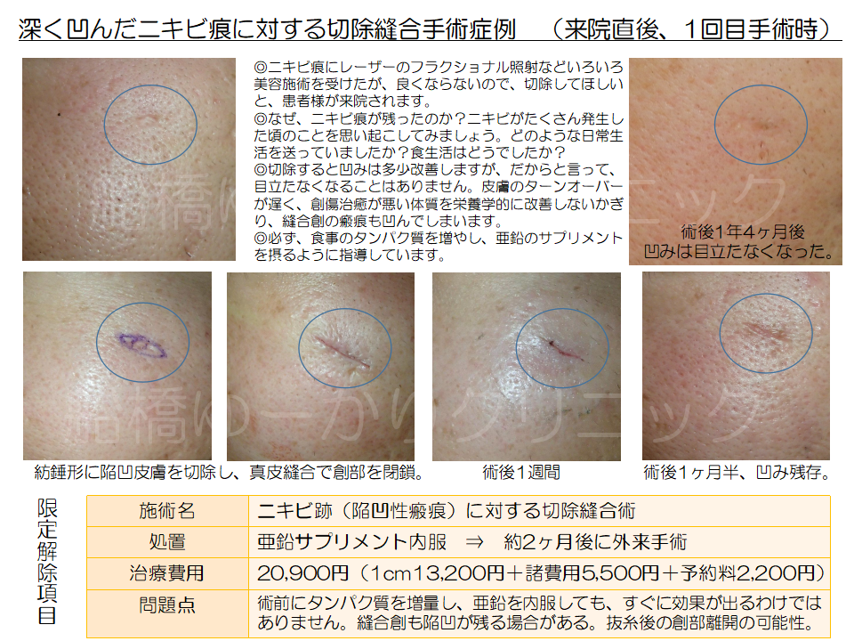 ニキビ跡治療学会発表
