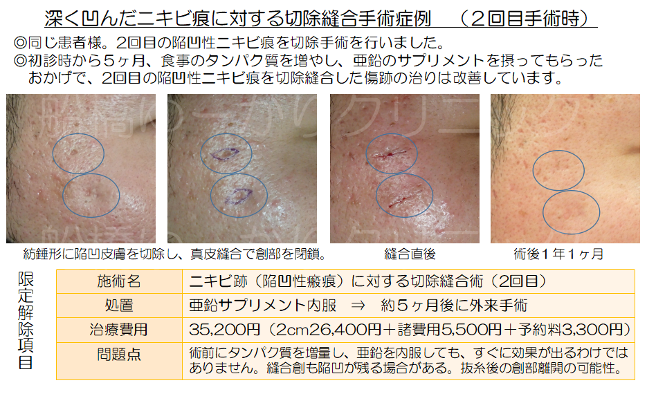 ニキビ跡治療学会発表