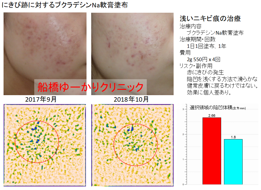ニキビ跡治療学会発表