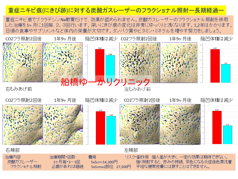 ニキビ跡治療学会発表
