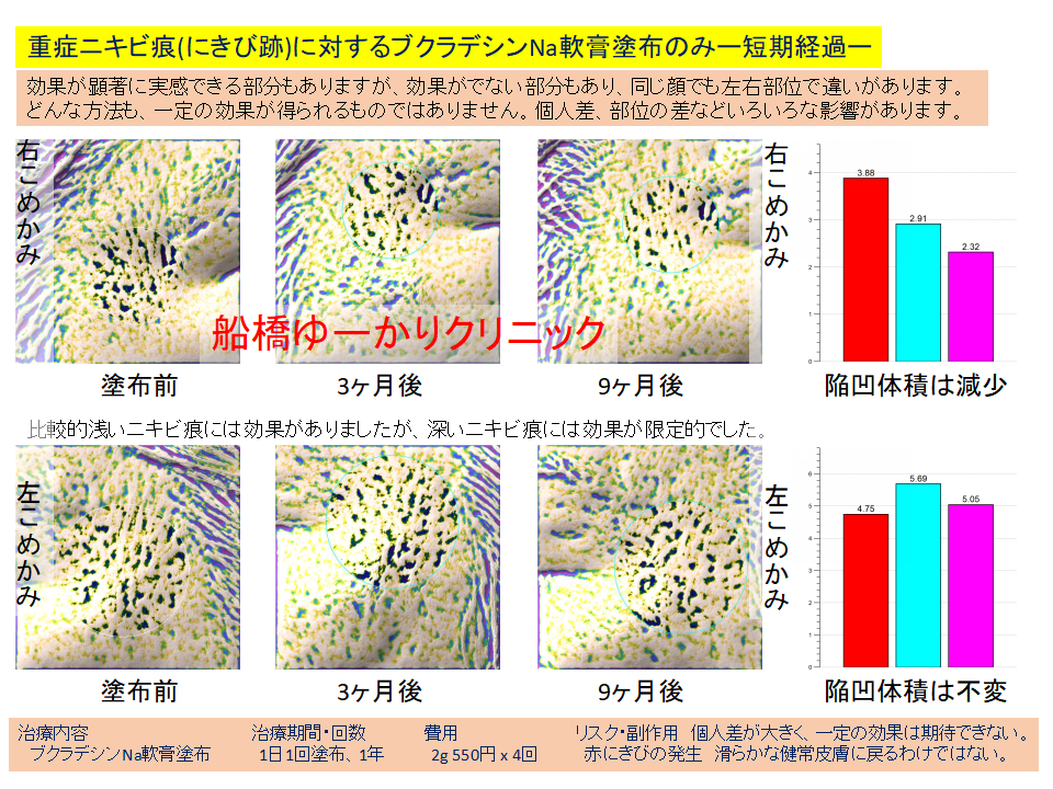 ニキビ跡治療学会発表