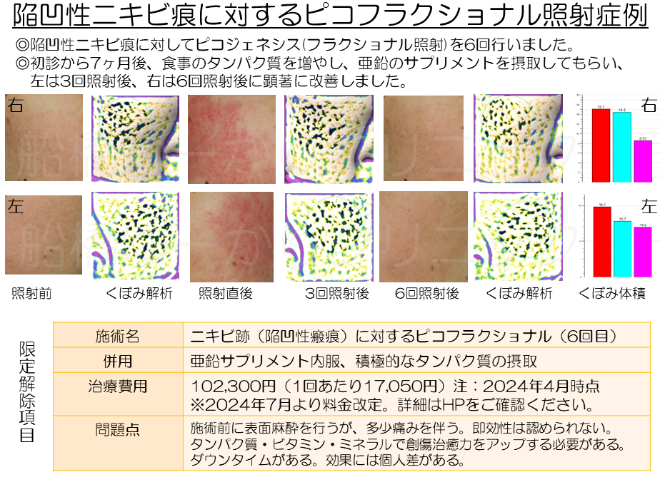 ニキビ跡治療学会発表