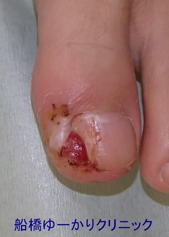 陥入爪治療症例