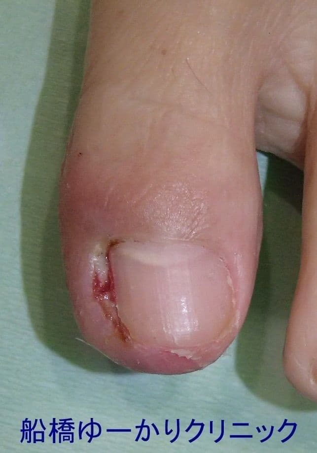 陥入爪治療症例