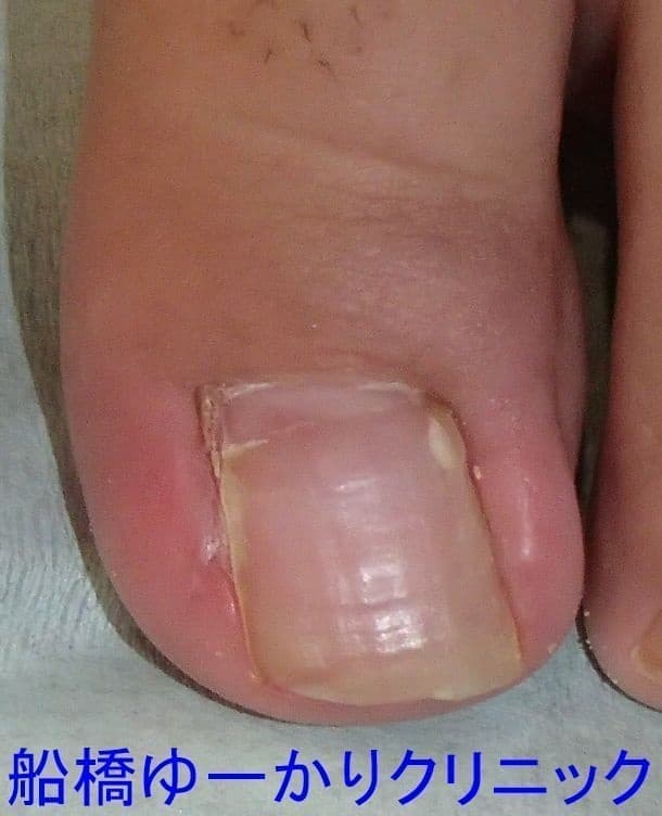 陥入爪治療例