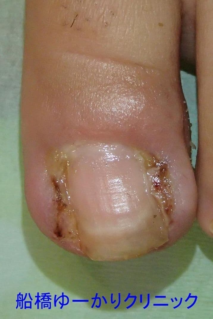 陥入爪治療例