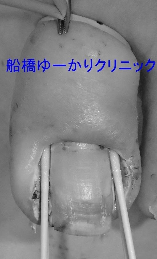 陥入爪治療例