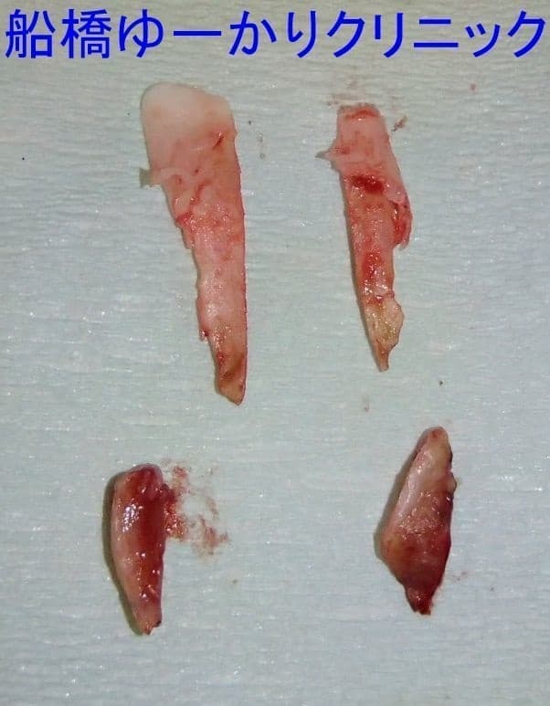 陥入爪治療例