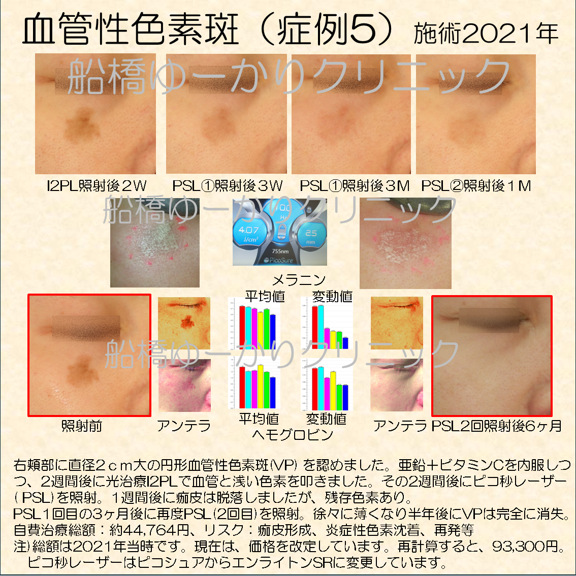 右頬部に直径2cm大の円形血管性色素斑(VP) を認めました。亜鉛+ビタミンCを内服しつつ、2週間後に光治療I2PLで血管と浅い色素を叩きました。その2週間後にピコ秒レーザー( PSL)を照射。1週間後に痂皮は脱落しましたが、残存色素あり。 PSL1回目の3ヶ月後に再度PSL(2回目)を照射。徐々に薄くなり半年後にVPは完全に消失。 自費治療総額:約44,764円、リスク:痂皮形成、炎症性色素沈着、再発等 注)総額は2021年当時です。現在は、価格を改定しています。再計算すると、93,300円。 ピコ秒レーザーはピコシュアからエンライトンSRに変更しています。