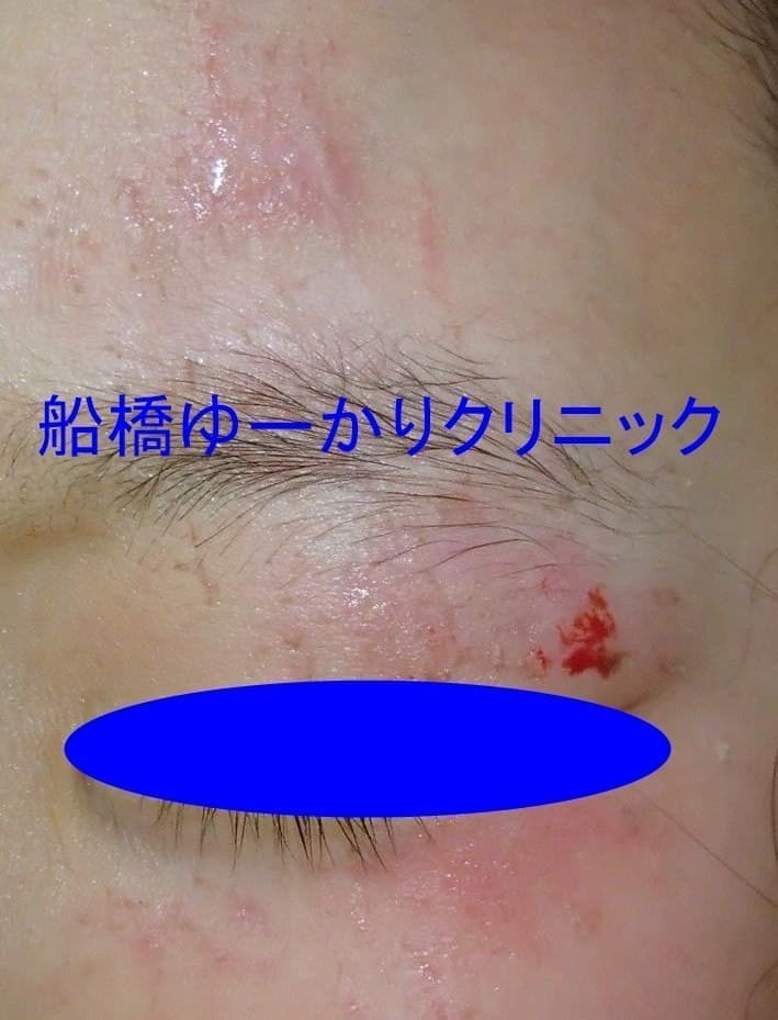 擦過傷症例1