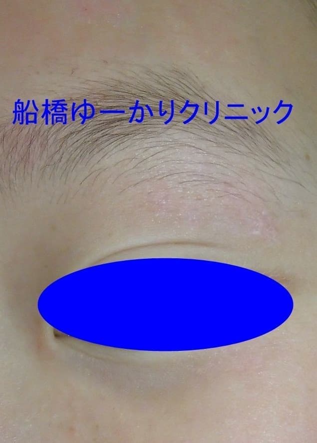 擦過傷症例1