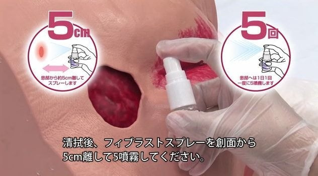 フィブラスト