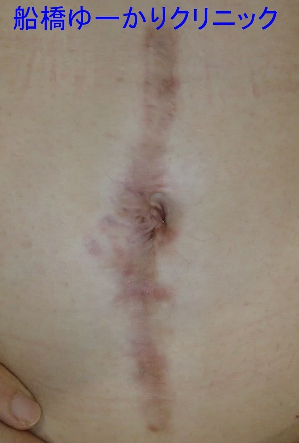 腹部ケロイド