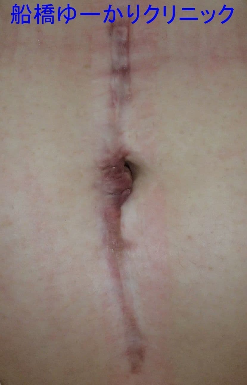 腹部ケロイド