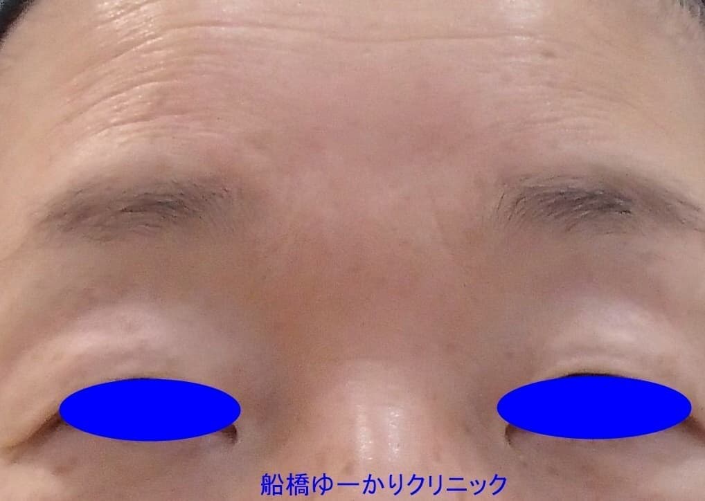 眼瞼下垂症例