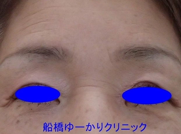 眼瞼下垂症例