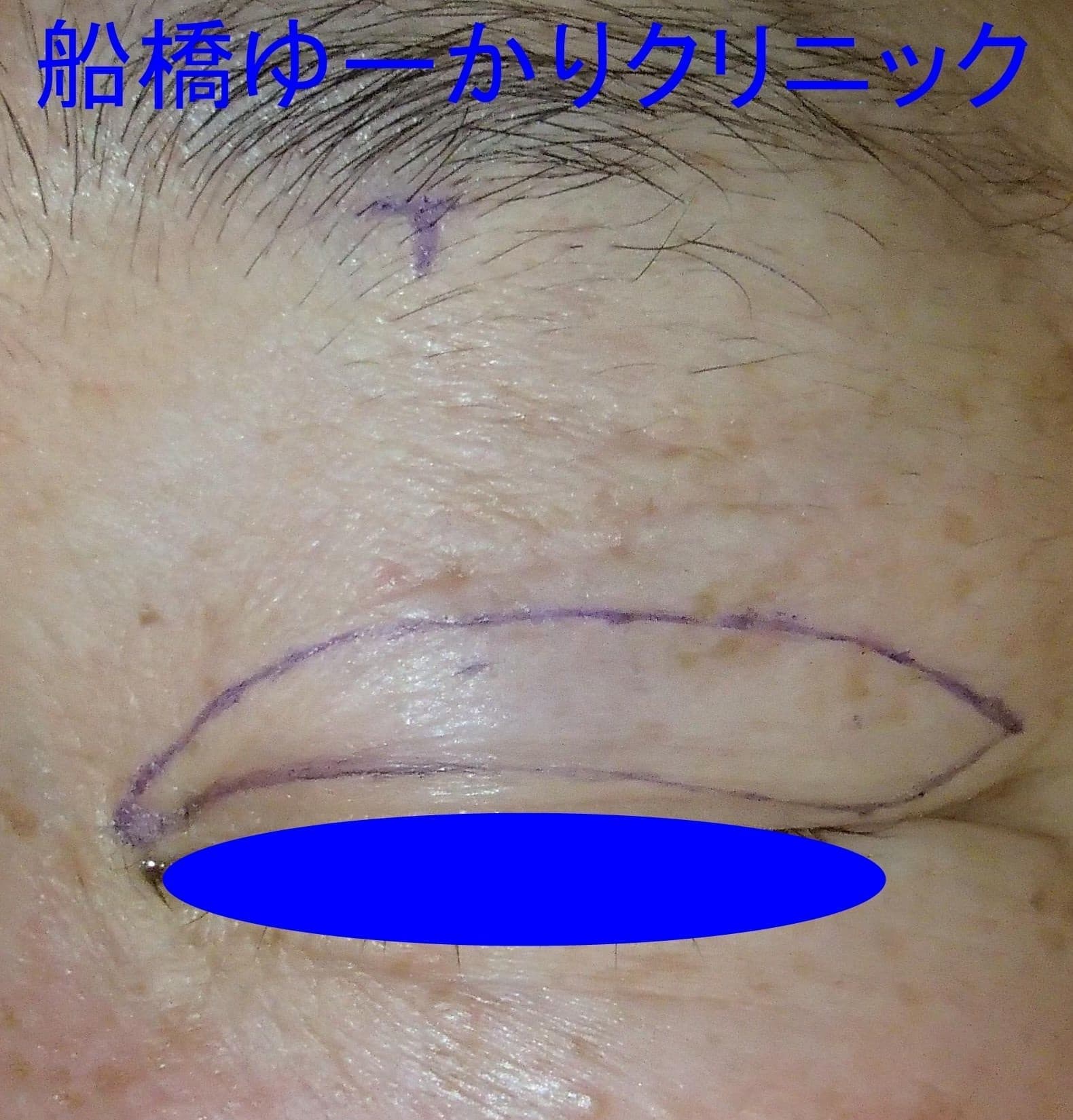 眼瞼下垂症例