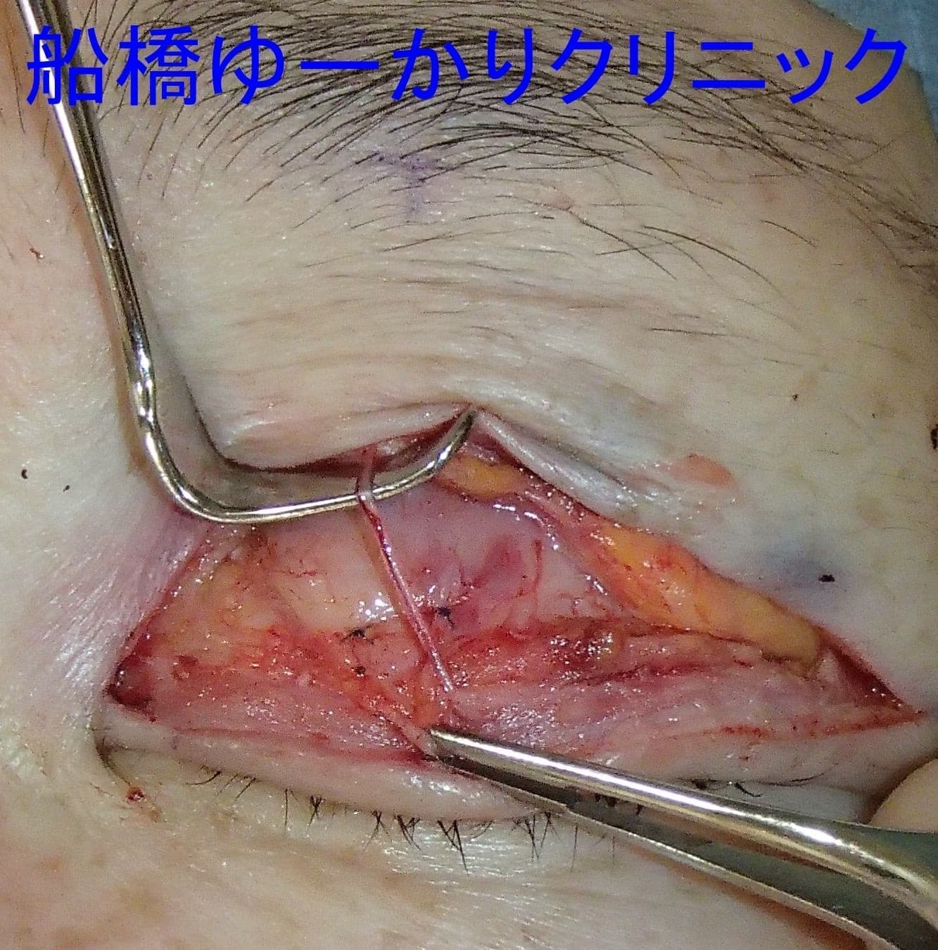 眼瞼下垂症例