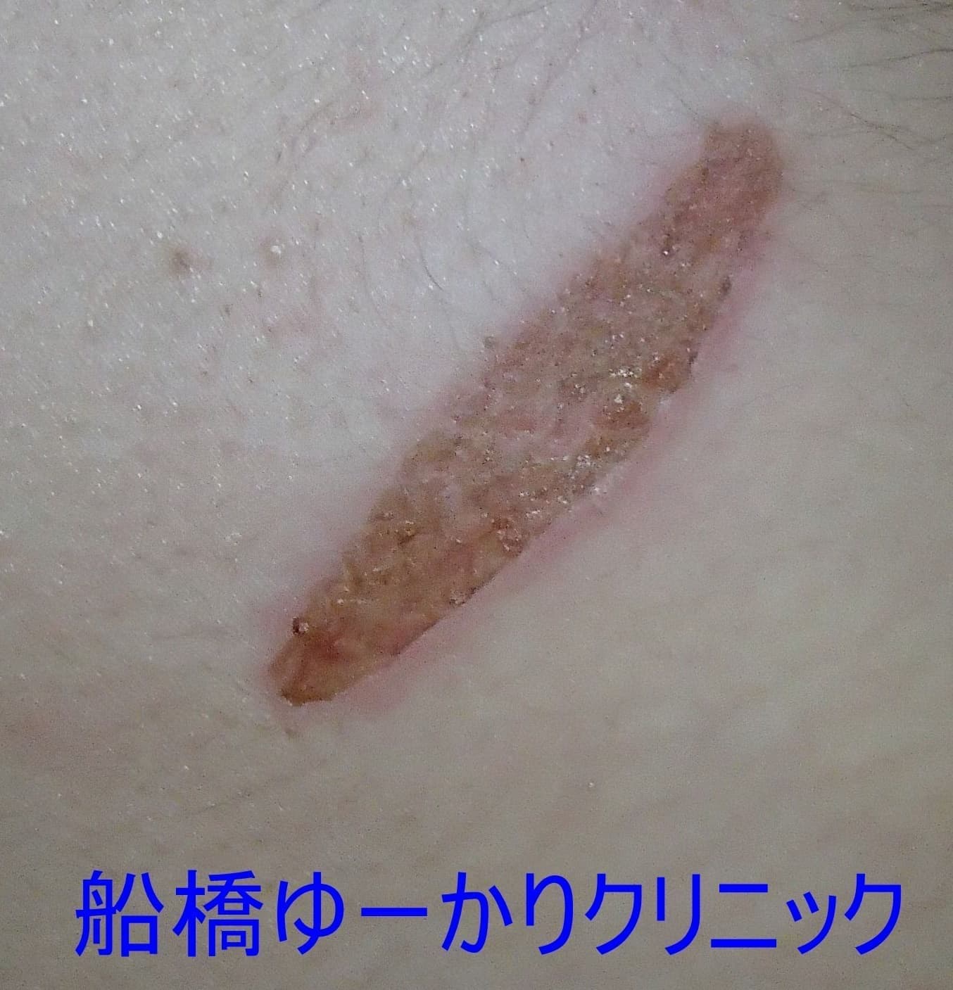 ヘアアイロンやけど