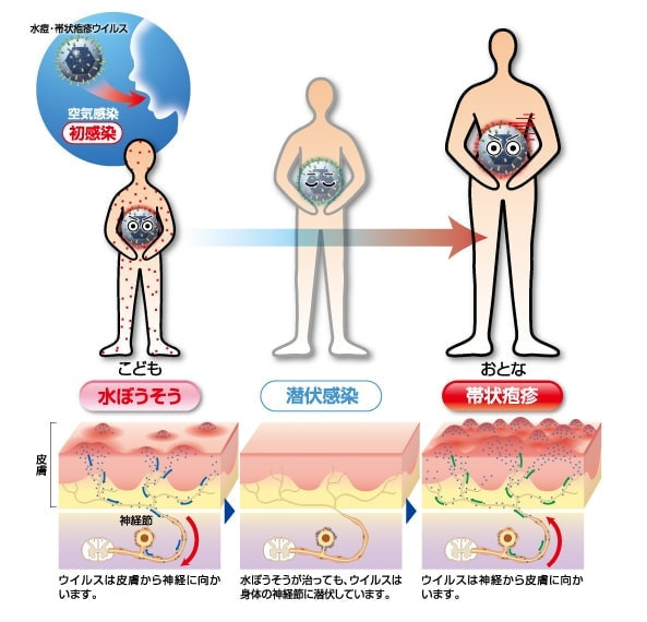 帯状疱疹の図
