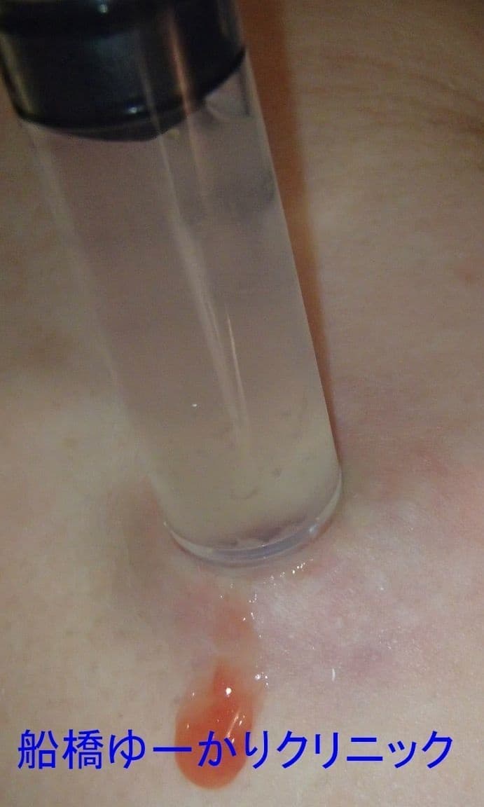 化膿した粉瘤の治療