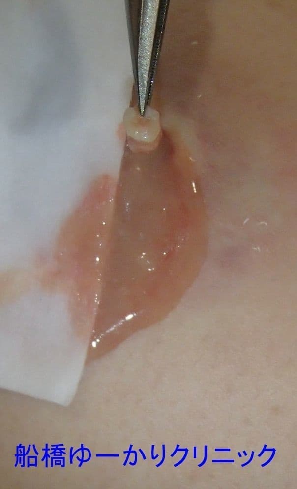 化膿した粉瘤の治療