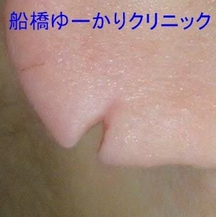 耳垂裂