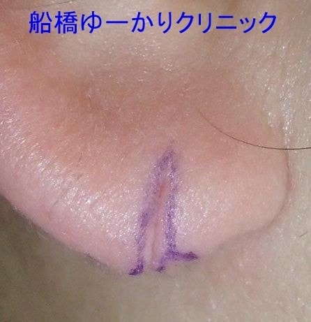 耳垂裂