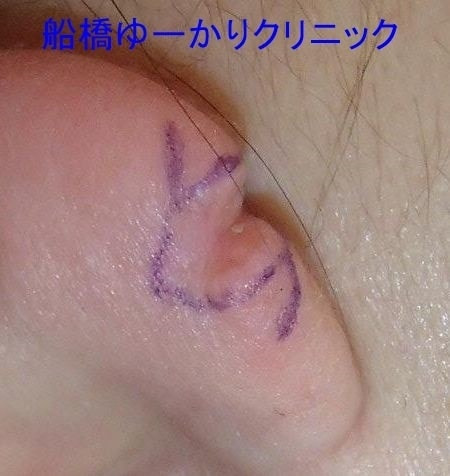 耳垂裂