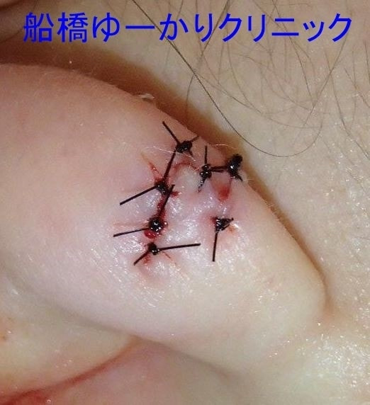耳垂裂