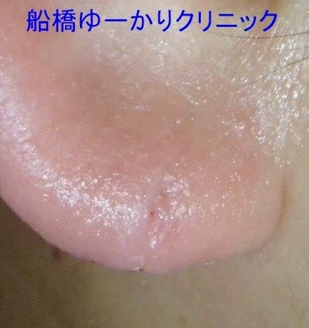 耳垂裂