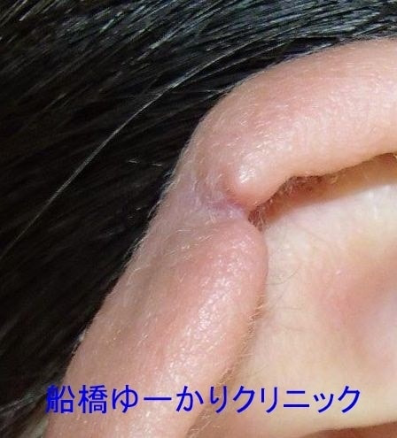 耳輪裂