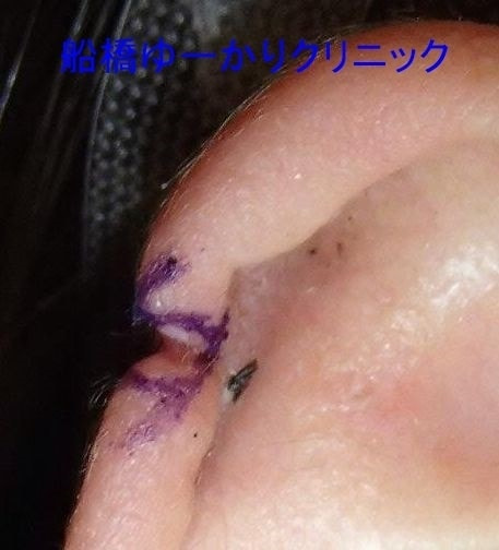 耳輪裂