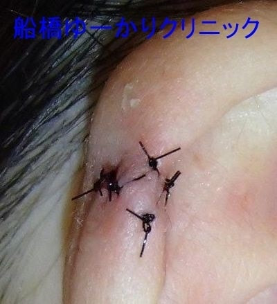 耳輪裂