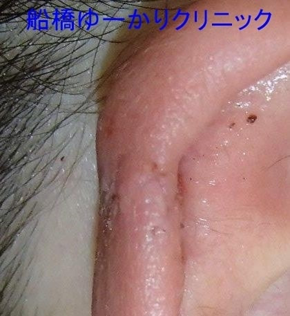 耳輪裂