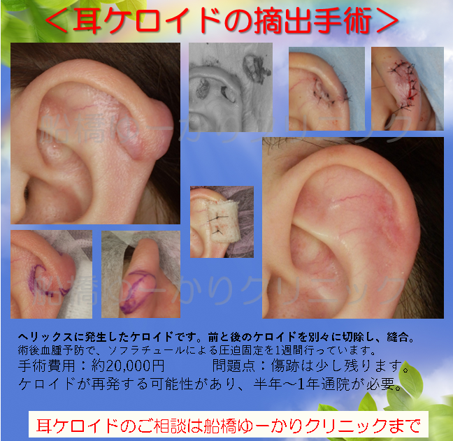 耳ケロイド摘出症例
