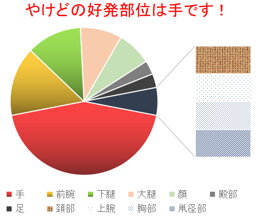 やけど統計