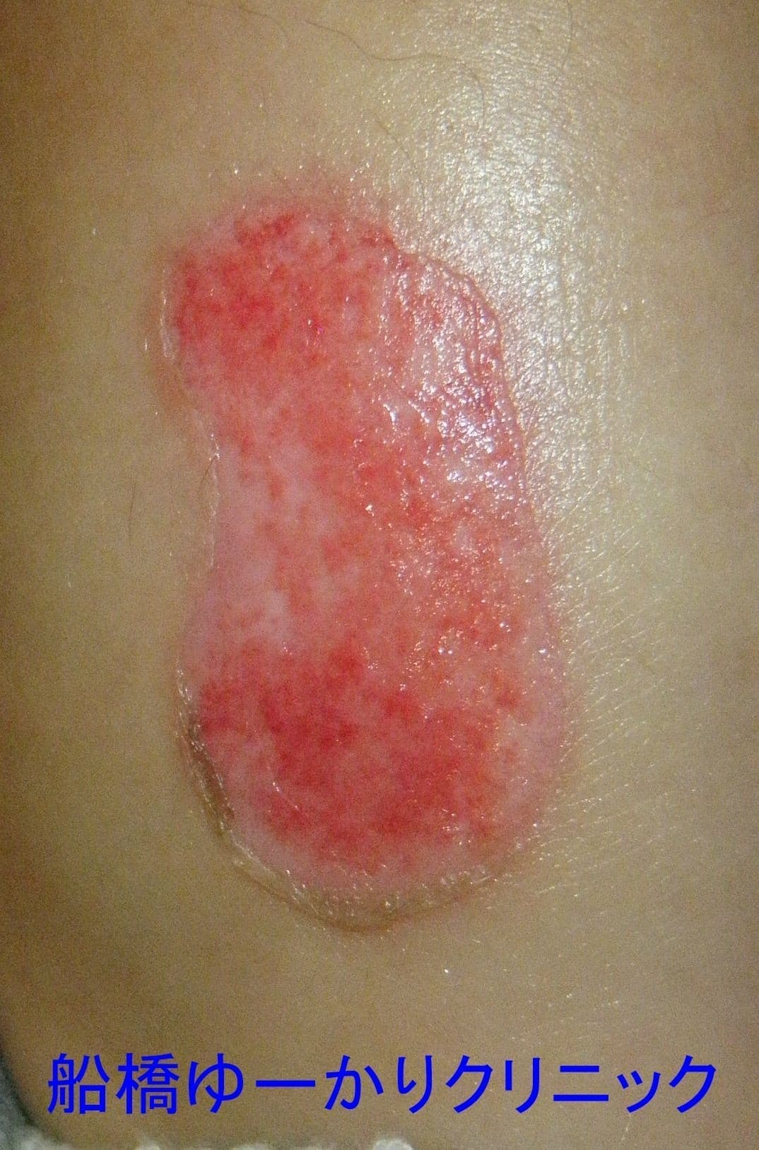 湯たんぽやけど