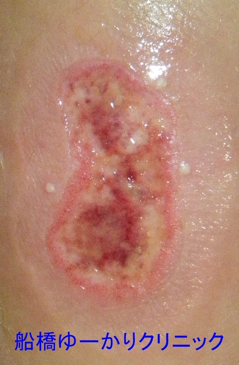 湯たんぽやけど