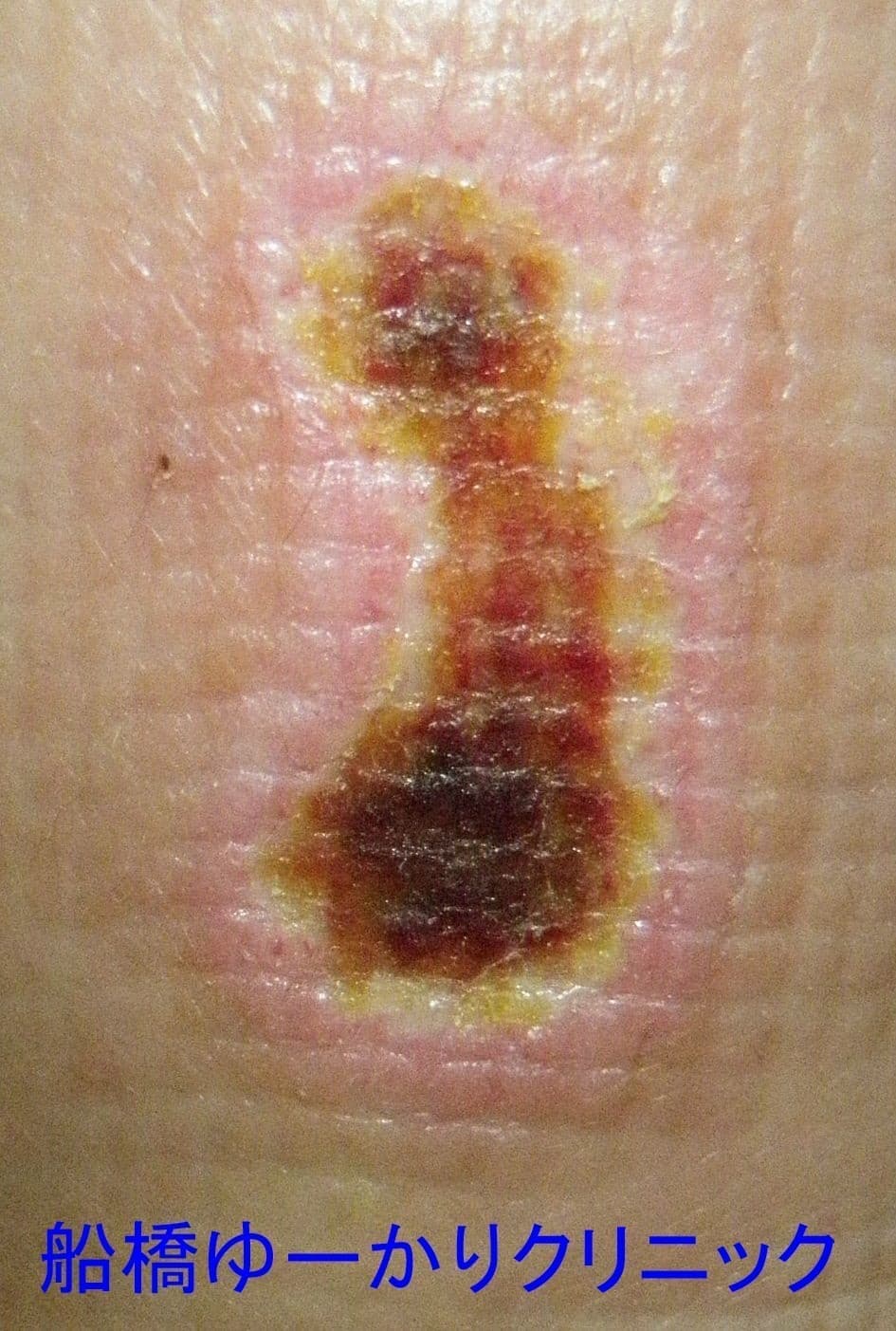 湯たんぽやけど