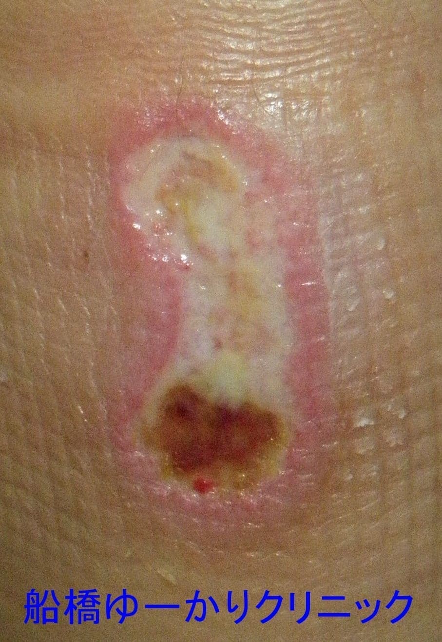 湯たんぽやけど