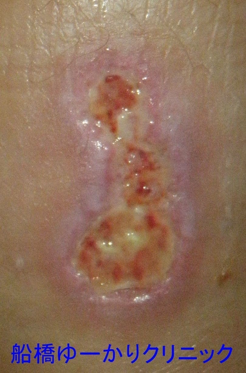 湯たんぽやけど