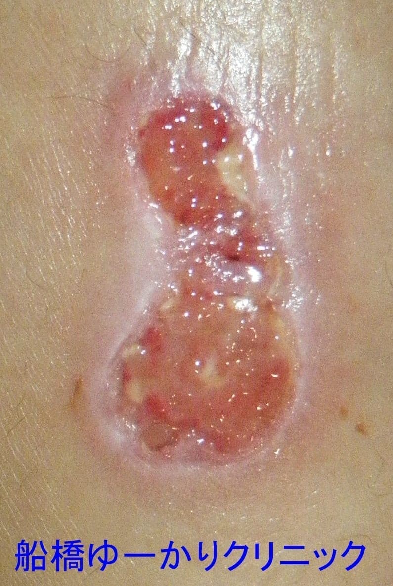 湯たんぽやけど