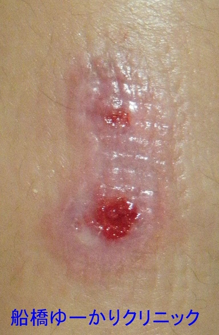 湯たんぽやけど