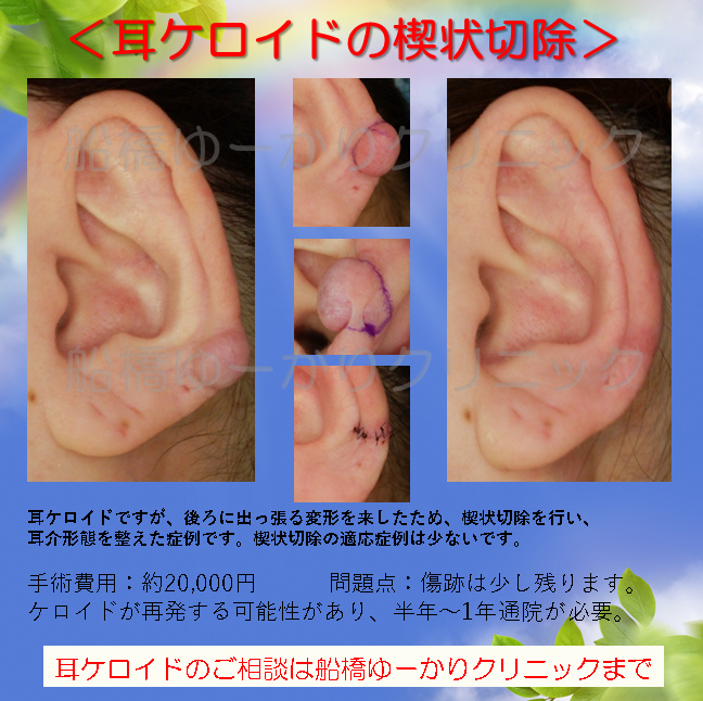 耳ケロイド摘出症例