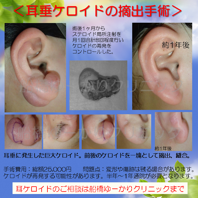 耳ケロイド摘出症例