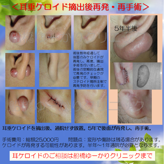 耳ケロイド摘出症例